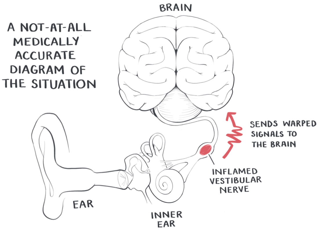 A diagram of the vestibular nerve sending mixed signals to the brain